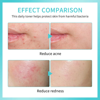 PH Balancing Toner Daily Rescue Facial Spray for Sensitive Skin Hypochlorous Acid Spray Helps Reduce Redness Breakouts Soothing